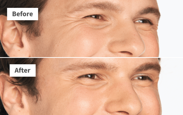 Preston, crow’s feet before and after