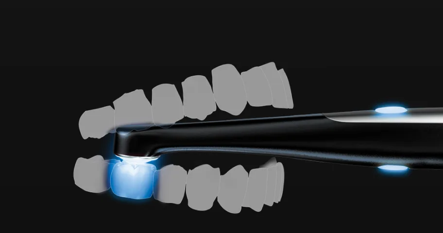 VALO curing light accessing posterior teeth