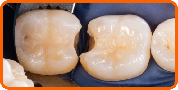 Initial decay was removed on teeth #30 and #31