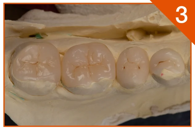 Indirect restoration with A2B on cast model