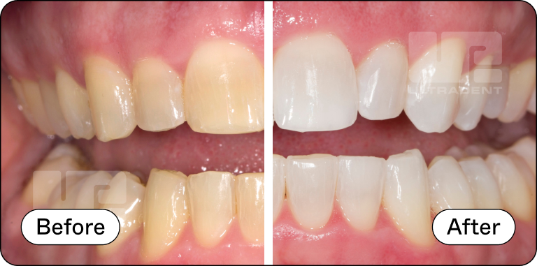 Opalescence Custom Before and After 1