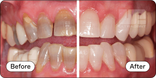 Opalescence Pro Before and After 5