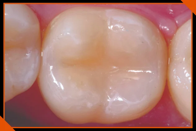 Posterior restoration result