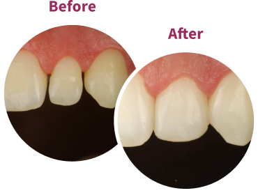 Lateral Incisors Restoration