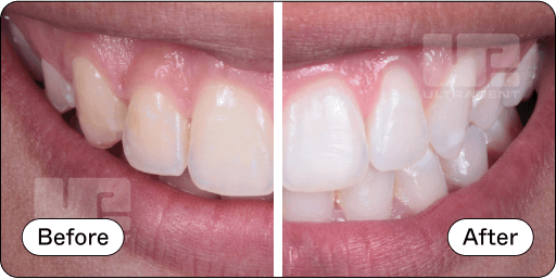 Opalescence Pro Before and After 6