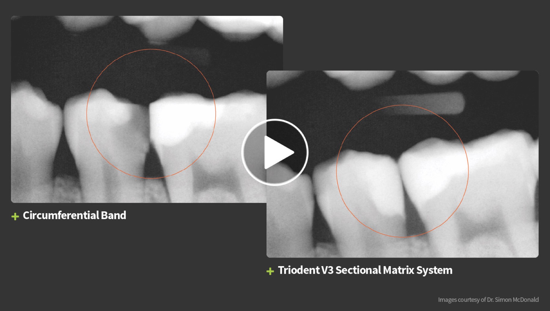 Watch the Triodent difference