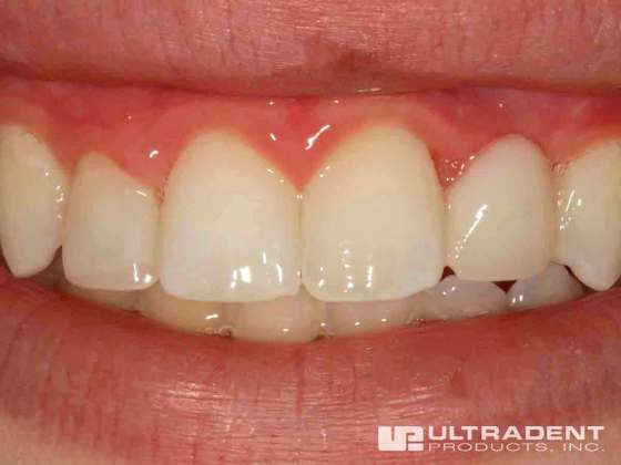 Do all veneers glow under UV lights?! #veneer #veneers