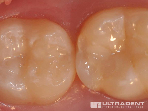 UltraSeal XT hydro