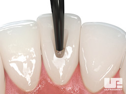 Opalescence Endo Procedure - Walking Bleach Technique 2