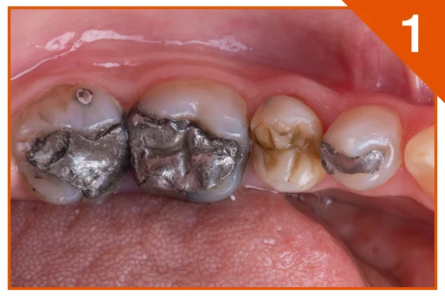 Initial posterior onlay situation