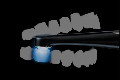 VALO XG light covering a large tooth restoration