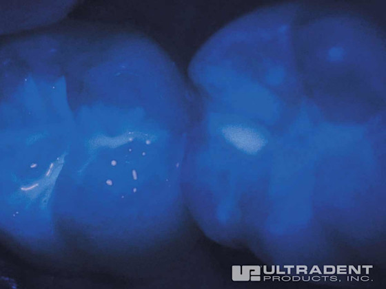 UltraSeal XT hydro
