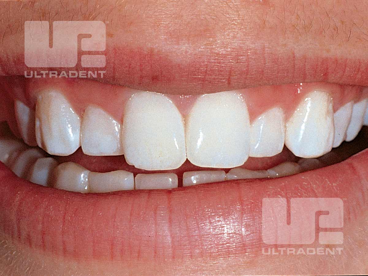 opalescence carbamide peroxide teeth whitening