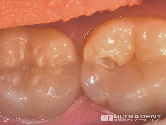 UltraSeal XT hydro