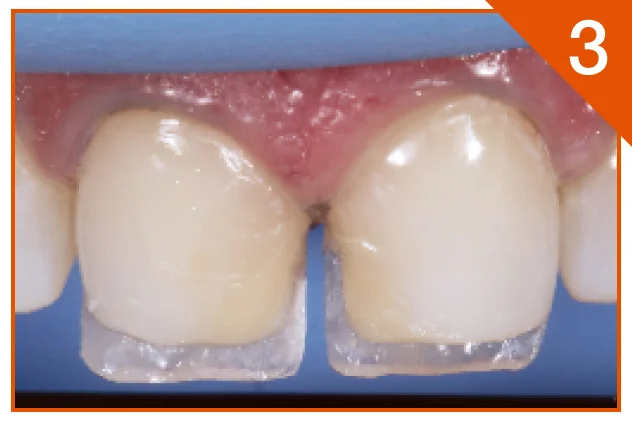 Deep dentine layer placed using A3D shade
