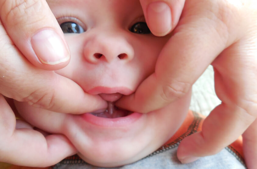 Infant Pediatrics dentistry