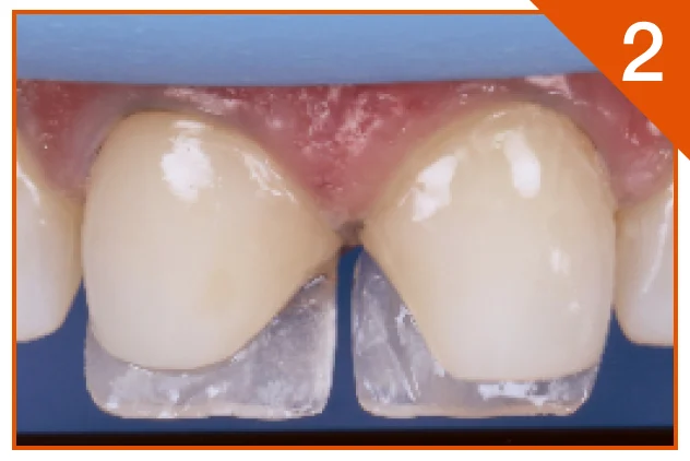 Palatal shell reproduced using a silicone wall and incisal shade