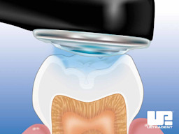 4 UltraSeal-XT-hydro-Step-by-Step Light-Cure