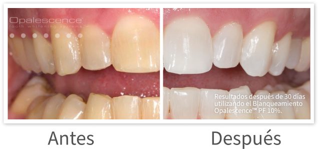 Opalescence PF Before and After