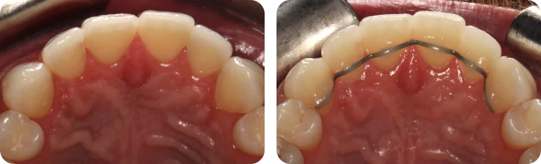 Upper retainer before and after placement