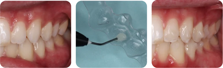 Aligner treatment before, during, and after attachment placement