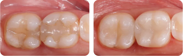 Restoration before and after treatment