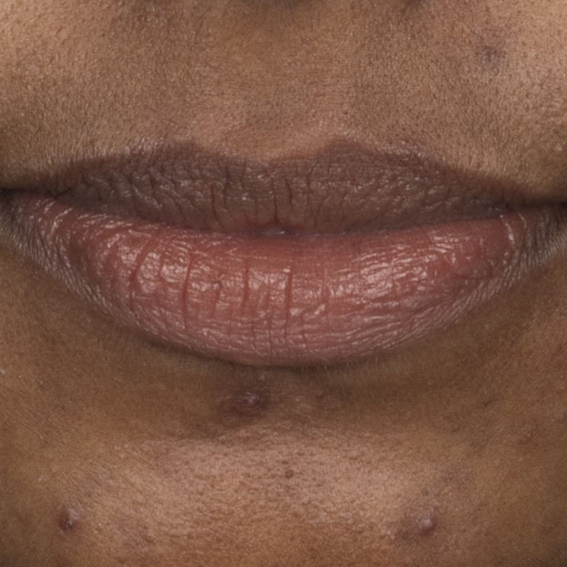 Dry chapped lips before lip mask