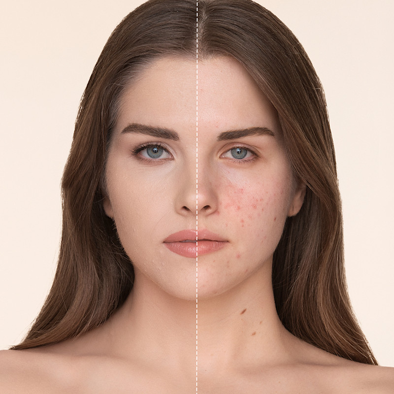 Makeup for acne-prone skin