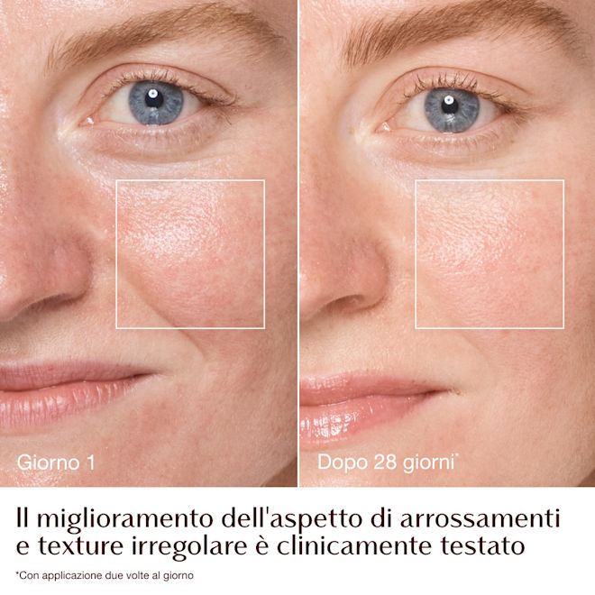 Magic Cream - infografica prima e dopo arrossamenti e grana - modella Emily Magic Cream - infografica prima e dopo arrossamenti e grana - modella Emily