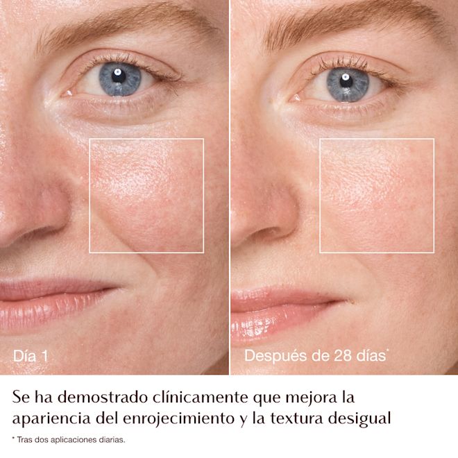 Infografía del antes y el después de la Magic Cream: enrojecimiento y textura: modelo Emily Infografía del antes y el después de la Magic Cream: enrojecimiento y textura: modelo Emily