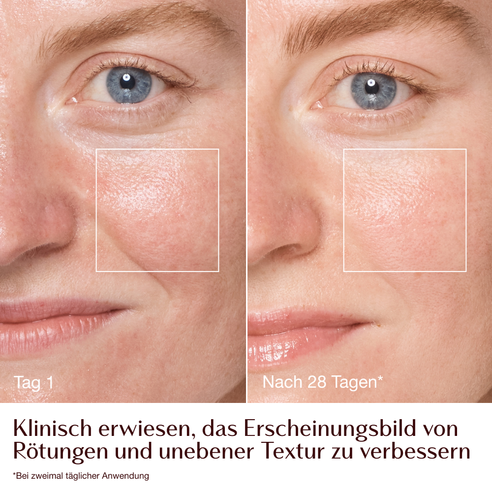 Magic Cream – Vorher-Nachher-Bilder von Rötungen und Textur − Model Emily 