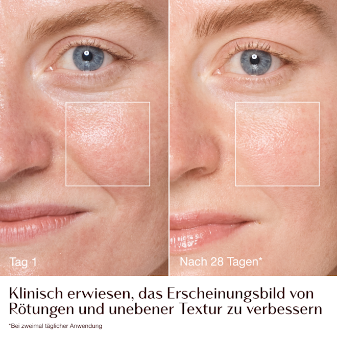 Magic Cream – Vorher-Nachher-Bilder von Rötungen und Textur − Model Emily Magic Cream – Vorher-Nachher-Bilder von Rötungen und Textur − Model Emily