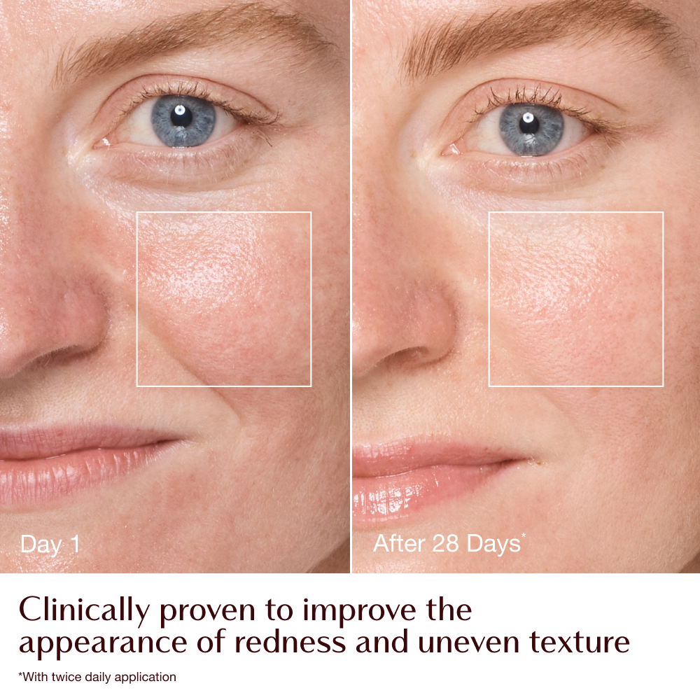 Magic Cream - before and after redness + texture infographic - model Emily 