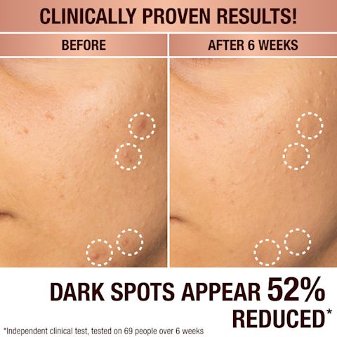 Comment réduire les taches brunes et l'hyperpigmentation avec le Dark Spot Serum