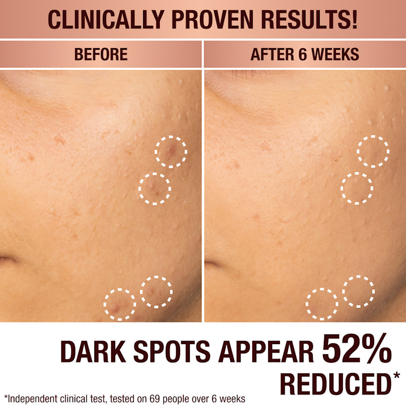 Dark spot serum prima e dopo macchie scure