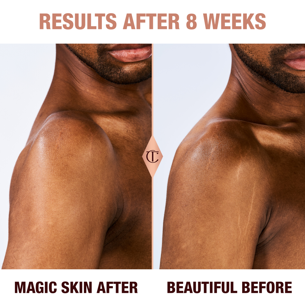 Magic Body Cream on Stretch Marks results after 8 weeks