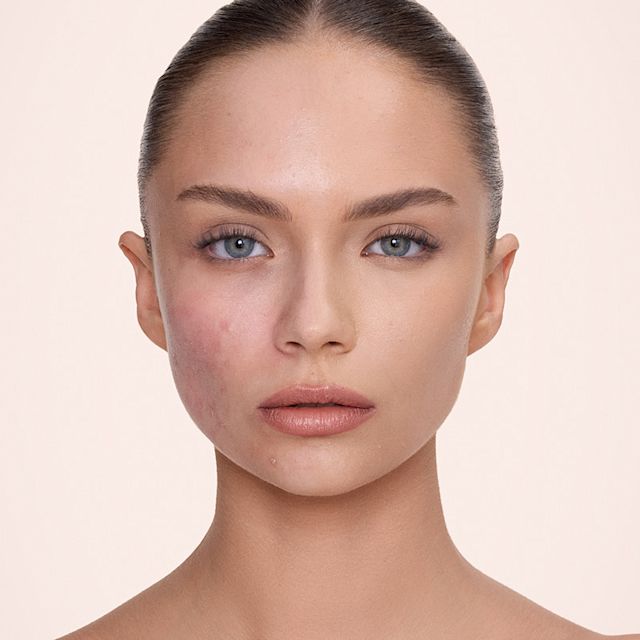 Cómo cubrir el enrojecimiento con maquillaje antes y después