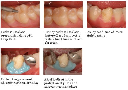 Dental Air Abrasion What Dentists Need to Know About This New Dental