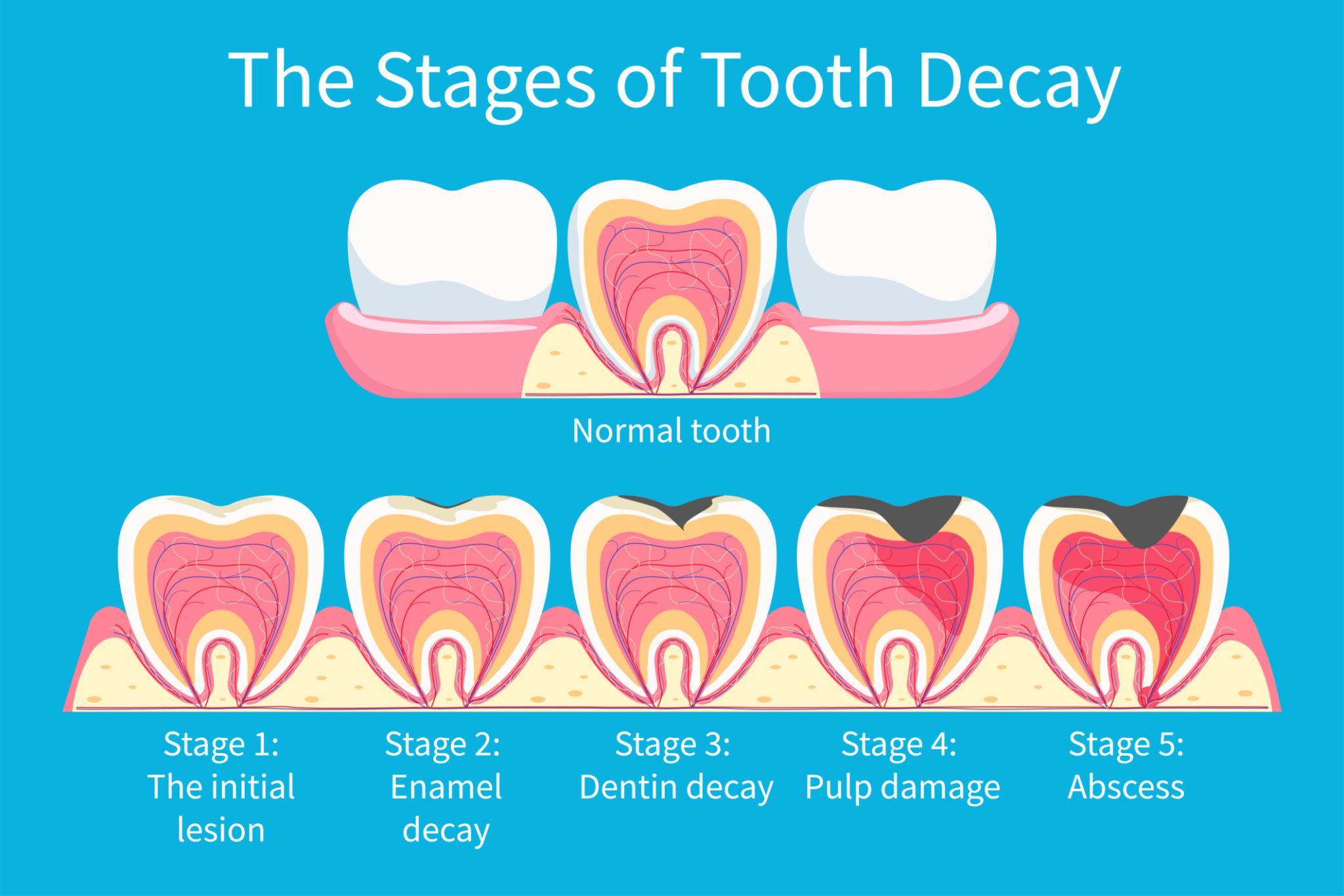 cavity