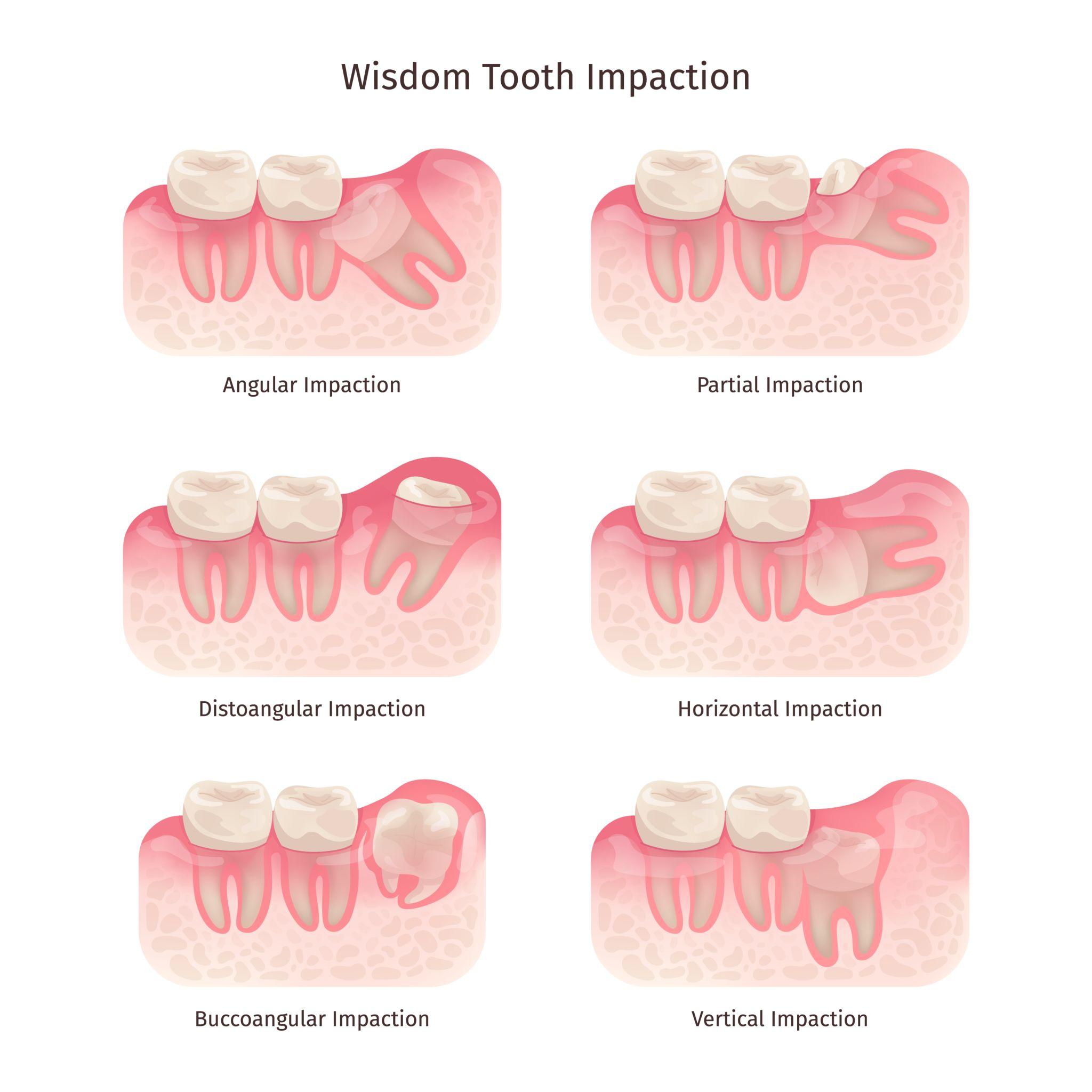 Impacted tooth