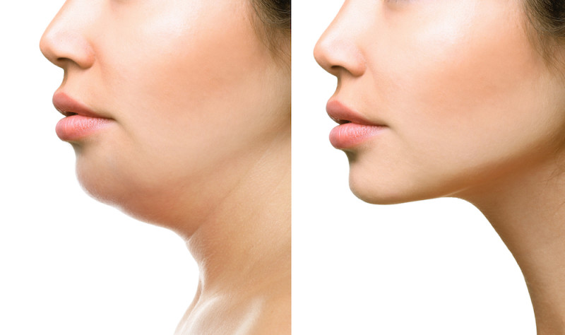 Fat Dissolving Injections - Can You Really ‘Melt Away’ A Double Chin?