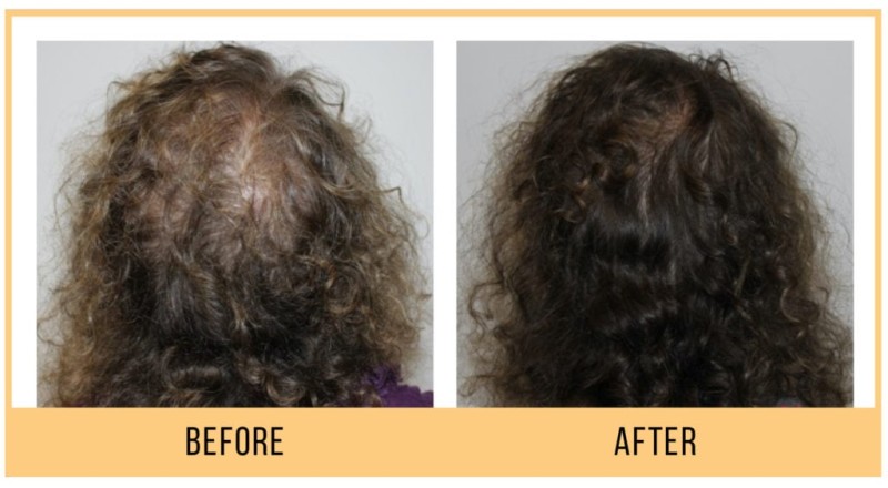 Keravive Hair Growth Treatment 