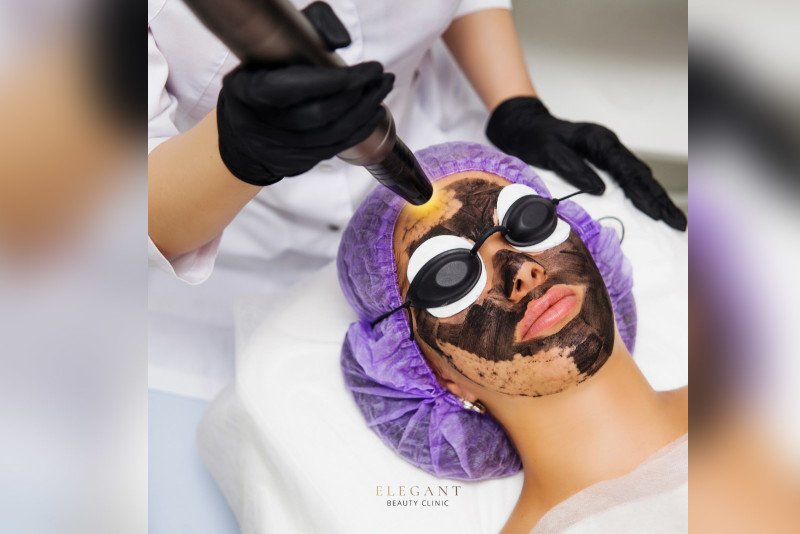 Carbon Facial Peel