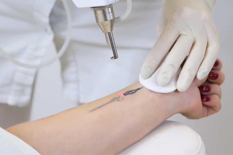 Lynton Laser Tattoo Removal