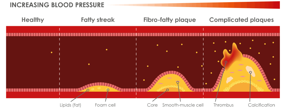 Progression de l'athérosclérose au fil du temps