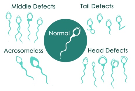 four common sperm defects