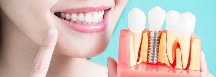 Sind Zahnimplantate richtig für mich? 