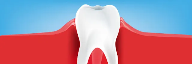 Gingivitis: Symptome, Ursachen und Behandlungen