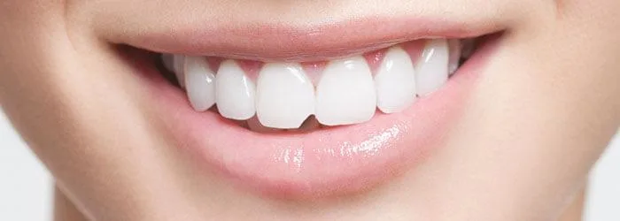 Abgeschlagene Zähne mithilfe von Dentalbonding reparieren 