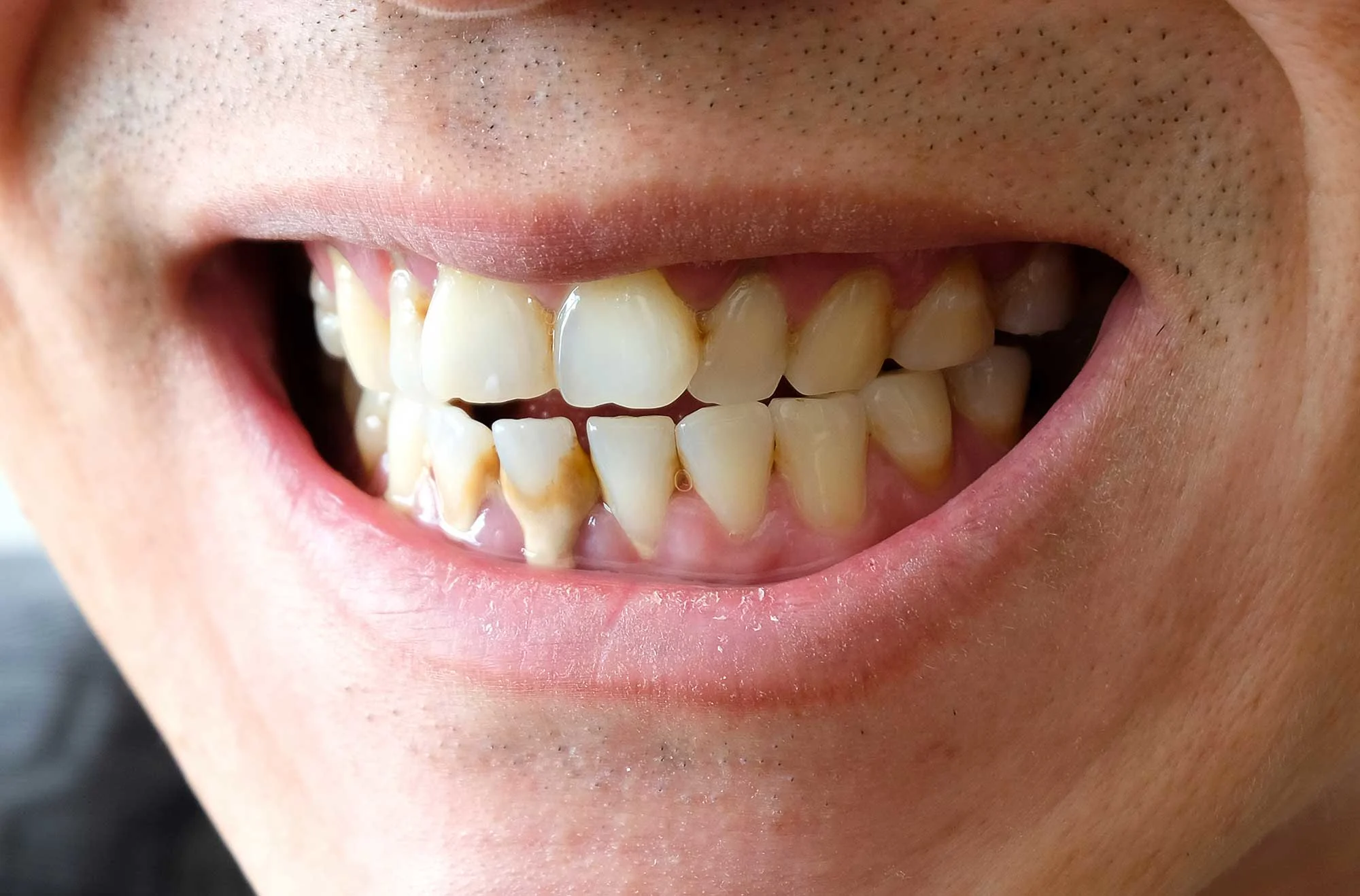 Image - Article - Zahnfleischchirurgie: Arten, Ablauf, Heilung und Nachsorge